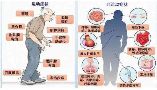 【科普促健康】帕金森病:中老年人的隐形杀手,你了解多少?