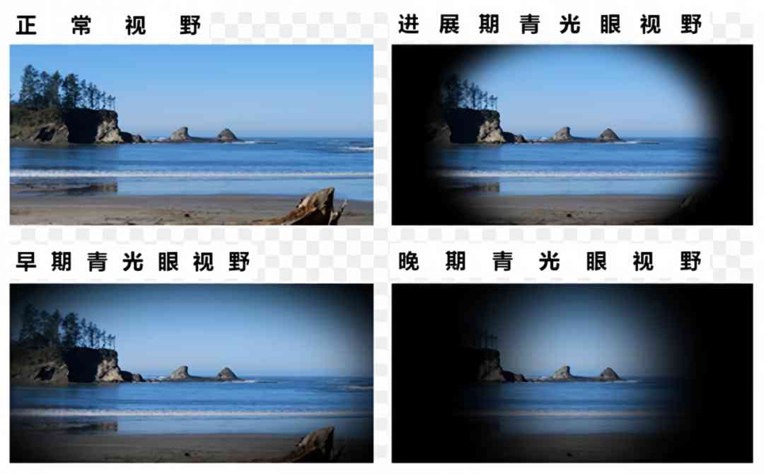 【科普促健康】世界青光眼日——别让“小偷”偷走你的光明