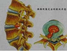 腰椎间盘突出症
